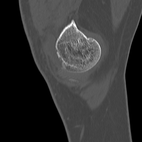 File:Anterior cruciate ligament avulsion fracture (Radiopaedia 58939-66194 Sagittal bone window 37).jpg
