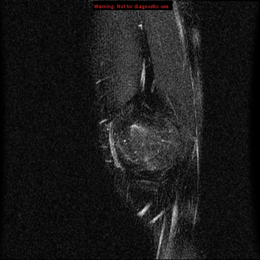 File:Anterior cruciate ligament injury - partial thickness tear (Radiopaedia 12176-12515 Sagittal T2 fat sat 2).jpg