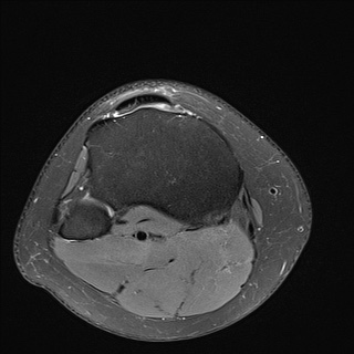 File:Anterior cruciate ligament rupture and posteromedial corner injury (Radiopaedia 67338-76723 Axial 28).jpg