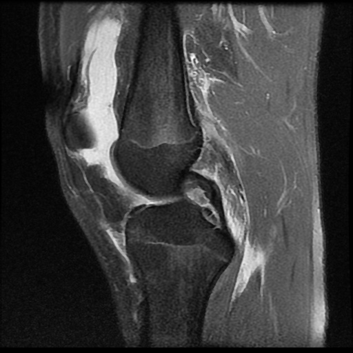File:Anterior cruciate ligament tear (Radiopaedia 61500-69462 Sagittal PD fat sat 8).jpg