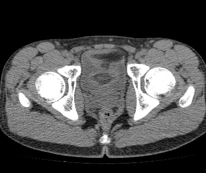 Anterior inferior iliac spine avulsion fracture (Radiopaedia 81312-94999 Axial non-contrast 56).jpg