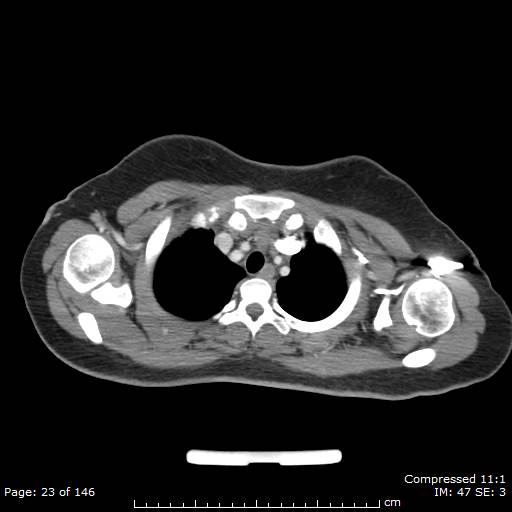 File:Anterior mediastinal B cell Lymphoma (Radiopaedia 50677-56114 A 12).jpg