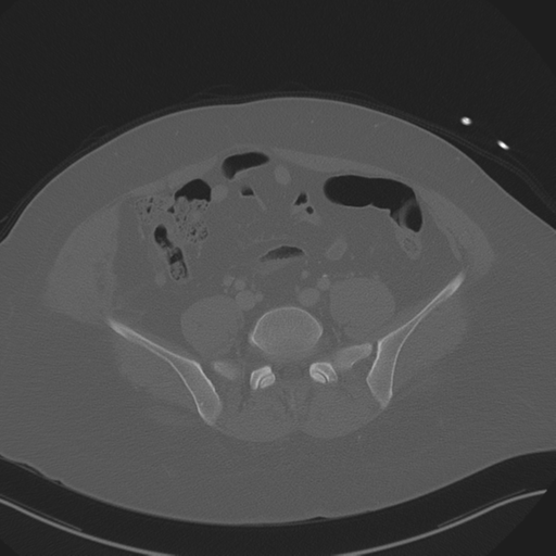 Anterior superior iliac spine avulsion fracture (Radiopaedia 44541-48244 Axial bone window 70).png