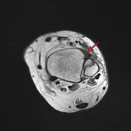 File:Anterior talofibular ligament injury - rupture with soft-tissue impingement (Radiopaedia 38765-66337 Annotated 2).jpg