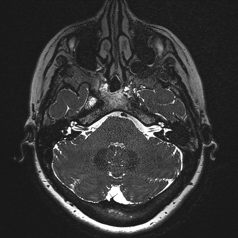Anterior temporal encephalocele (Radiopaedia 82624-96808 Axial T2 high res 13).jpg