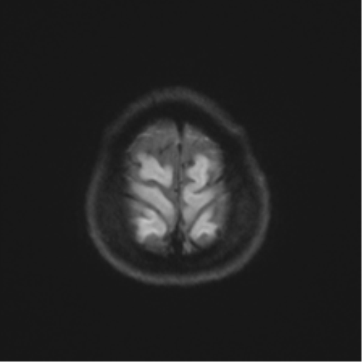 Anterior temporal lobe perivascular space (Radiopaedia 40946-43650 Axial DWI 53).png