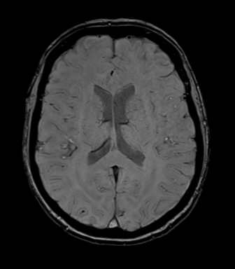 File:Anterior temporal lobe perivascular space (Radiopaedia 40946-43650 Axial SWI 50).png