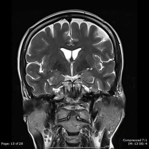 File:Anterior temporal lobe perivascular space (Radiopaedia 88283-104914 Coronal T2 13).jpg