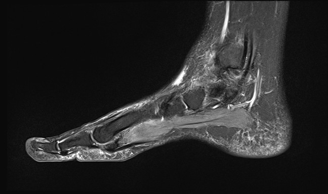 File:Anterior tibial artery false aneurysm (Radiopaedia 88984-105808 Sagittal STIR 21).jpg