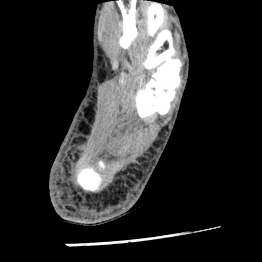 Anterior tibial artery false aneurysm (Radiopaedia 88984-105809 A 221).jpg