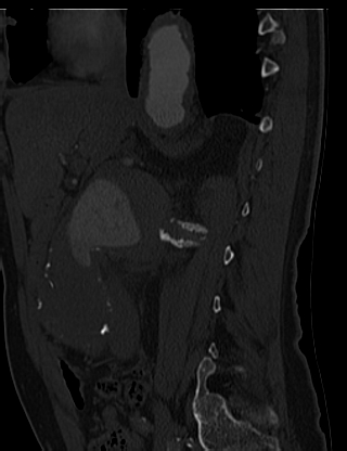 File:Anterior vertebral scalloping (abdominal aortic aneurysm) (Radiopaedia 66744-76067 Sagittal bone window 3).jpg