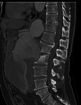 File:Anterior vertebral scalloping (abdominal aortic aneurysm) (Radiopaedia 66744-76067 Sagittal bone window 35).jpg