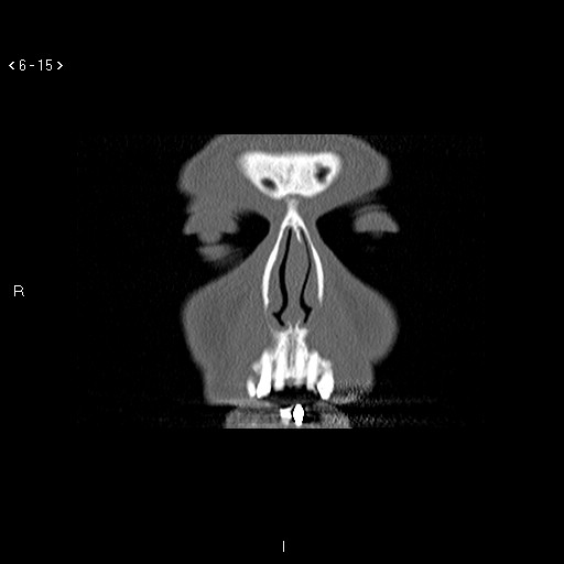 File:Antrochoanal Polyp (Radiopaedia 70510-80631 Coronal bone window 4).jpg