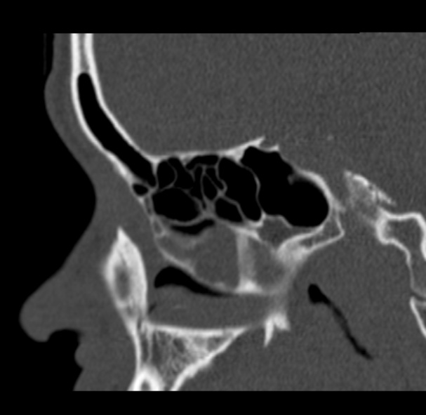 Antrochoanal polyp (Radiopaedia 33984-35202 Sagittal bone window 31).jpg