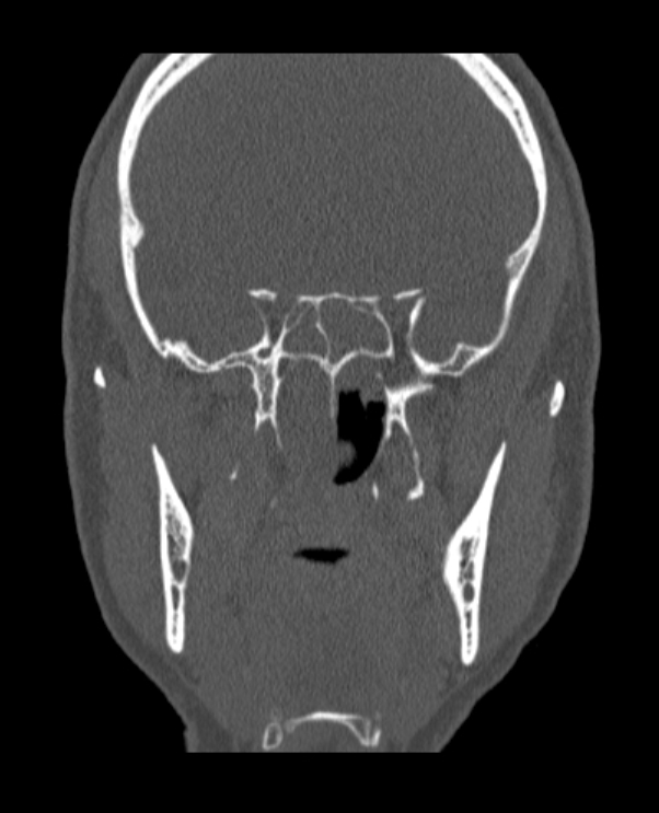 Antrochoanal polyp (Radiopaedia 79011-92169 Coronal bone window 26).jpg