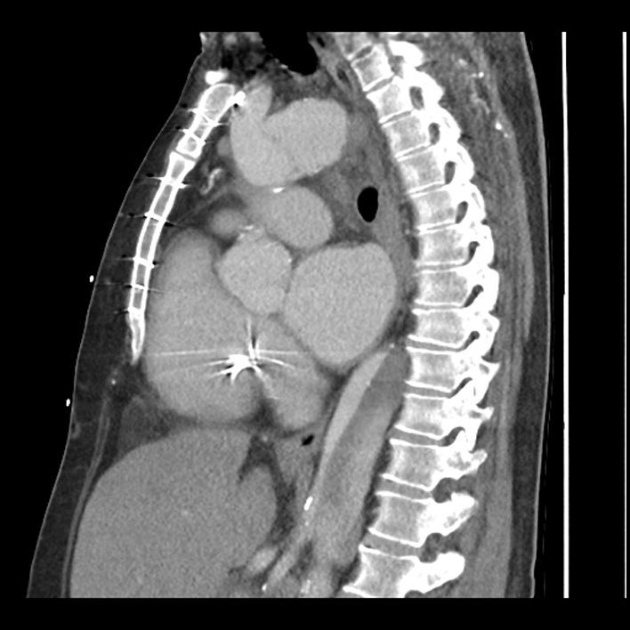 Aortic arch graft infection (FDG PET-CT) (Radiopaedia 71975-82437 C 37).jpg