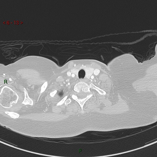Aortic arch origin of left vertebral artery (Radiopaedia 51520-57286 Axial lung window 13).jpg