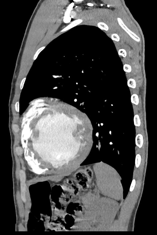 Aortic coarctation with aneurysm (Radiopaedia 74818-85828 B 123).jpg