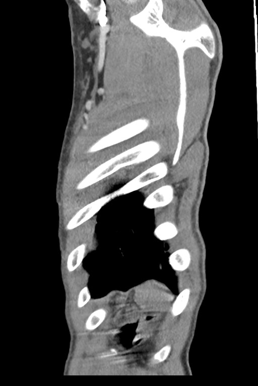 Aortic coarctation with aneurysm (Radiopaedia 74818-85828 B 145).jpg