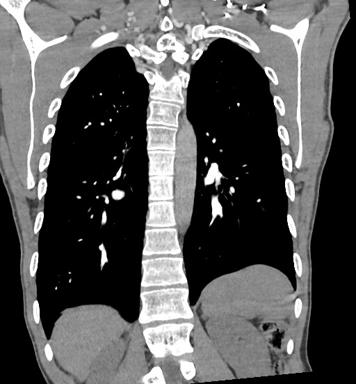 File:Aortic coarctation with aneurysm (Radiopaedia 74818-85828 C 84).jpg