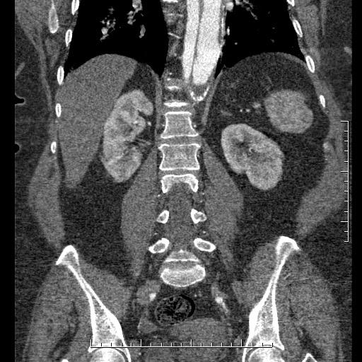 Aortic dissection- Stanford A (Radiopaedia 35729-37268 F 14).jpg