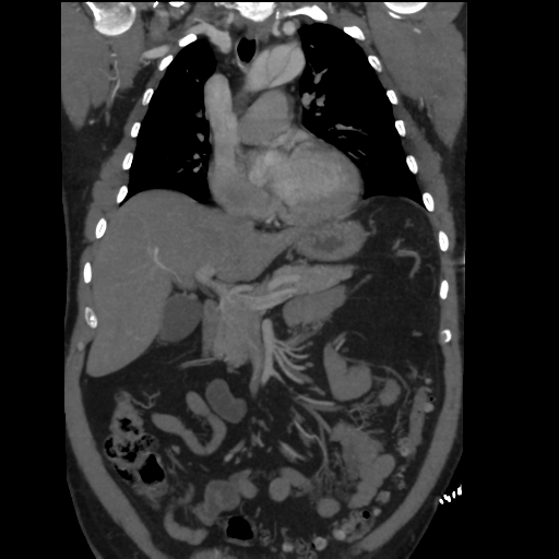 File:Aortic dissection- Stanford A (Radiopaedia 37759-39664 Coronal C+ delayed 19).png