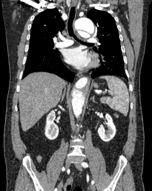 Aortic dissection (Radiopaedia 44411-48061 A 30).jpg