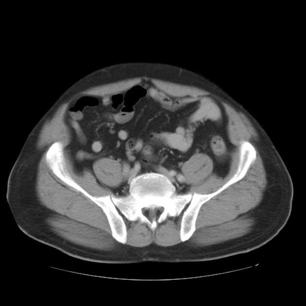 Aortic dissection (Radiopaedia 44411-48061 C 92).jpg