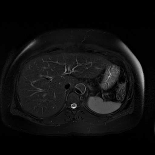 File:Aortic dissection (Radiopaedia 57969-64956 Axial T2 fat sat 19).jpg