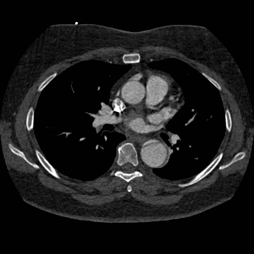File:Aortic dissection (Radiopaedia 57969-64959 A 153).jpg