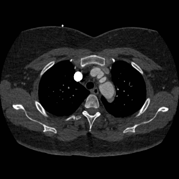 Aortic dissection (Radiopaedia 57969-64959 A 79).jpg