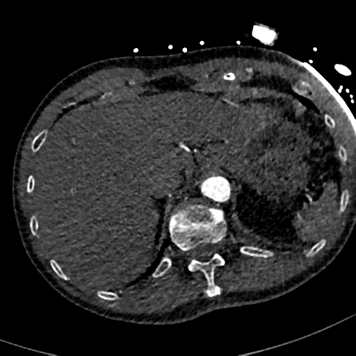 File:Aortic dissection - DeBakey type II (Radiopaedia 64302-73082 A 84).png