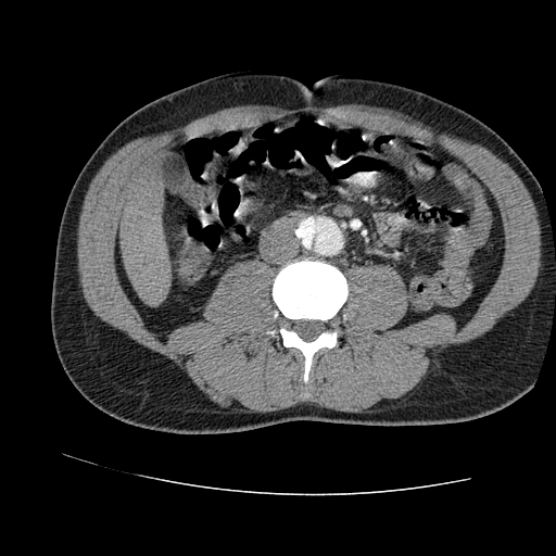 File:Aortic dissection - Stanford A -DeBakey I (Radiopaedia 28339-28587 B 149).jpg