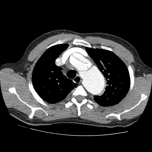 File:Aortic dissection - Stanford A -DeBakey I (Radiopaedia 28339-28587 B 8).jpg