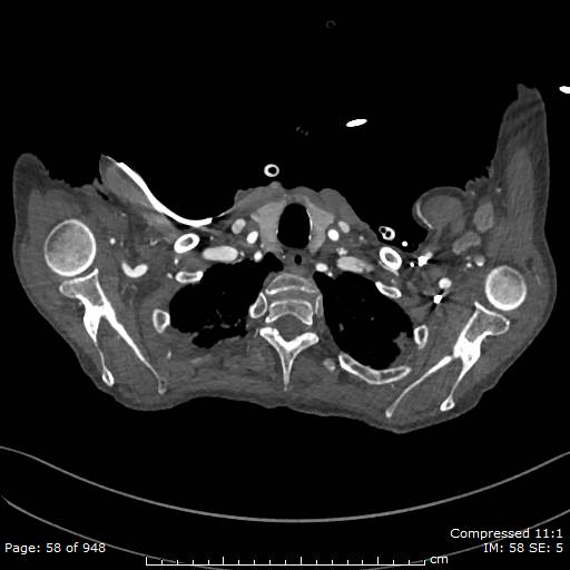 File:Aortic dissection with extension into aortic arch branches (Radiopaedia 64402-73204 B 58).jpg