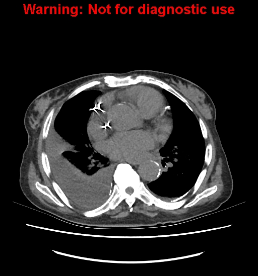 Aortic graft infection (Radiopaedia 44979-48907 Axial non-contrast 3).jpg