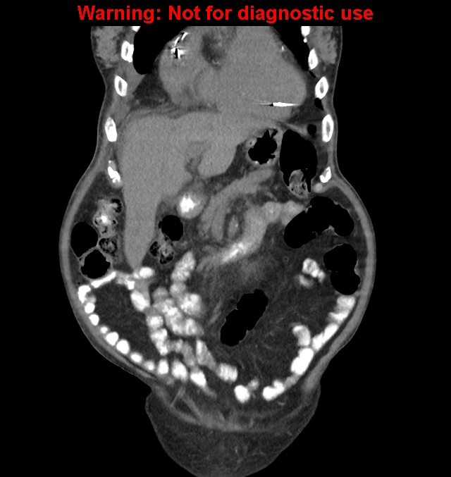 Aortic graft infection (Radiopaedia 44979-48907 non-contrast 14).jpg