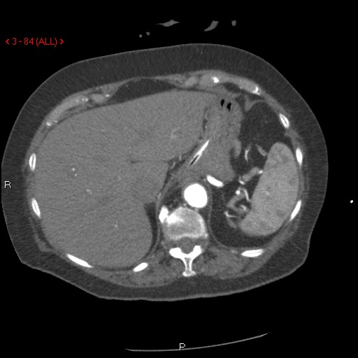 File:Aortic intramural hematoma (Radiopaedia 27746-28001 A 84).jpg