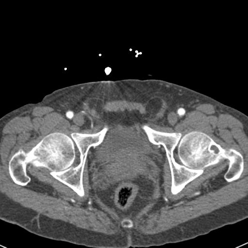 Aortic intramural hematoma (Radiopaedia 31139-31838 B 166).jpg