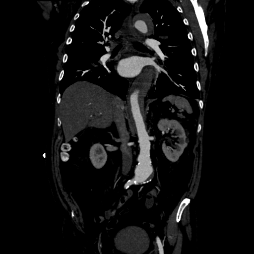Aortic intramural hematoma (Radiopaedia 34260-35540 C 49).png