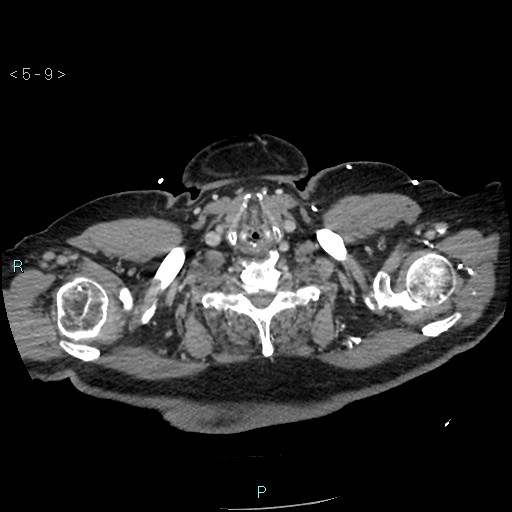 Aortic intramural hematoma (Radiopaedia 48463-53380 C 5).jpg