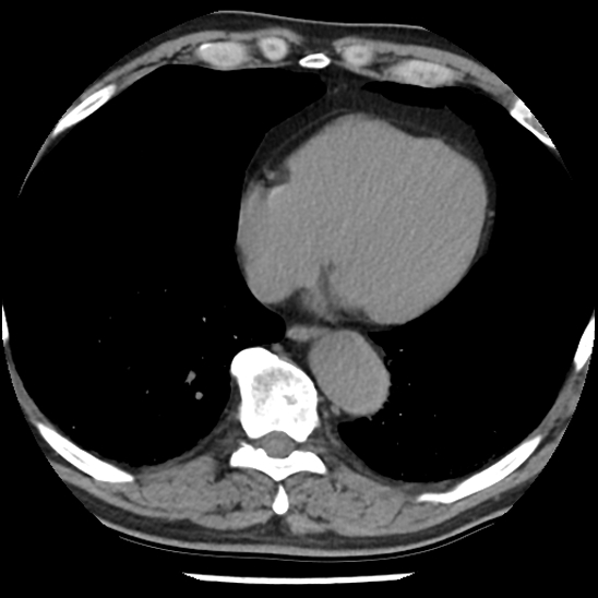 Aortic intramural hematoma (type B) (Radiopaedia 79323-92387 Axial non-contrast 38).jpg