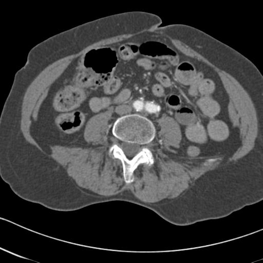 Aortic intramural hematoma from penetrating atherosclerotic ulcer (Radiopaedia 31137-31836 A 122).jpg