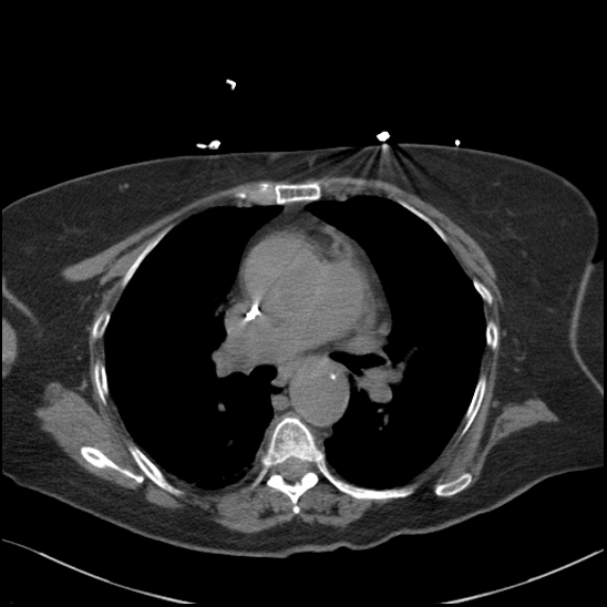 Aortic intramural hematoma with dissection and intramural blood pool (Radiopaedia 77373-89491 Axial non-contrast 44).jpg