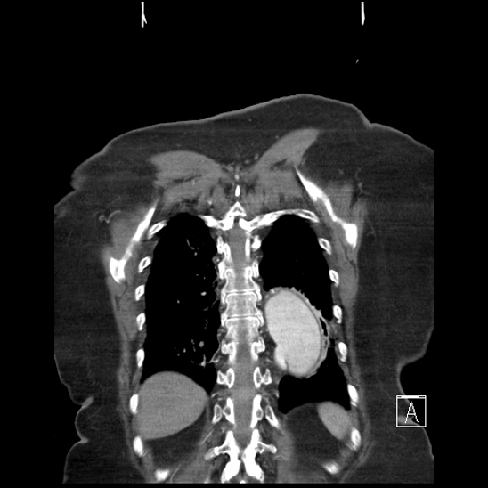 Aortic intramural hematoma with dissection and intramural blood pool (Radiopaedia 77373-89491 C 56).jpg