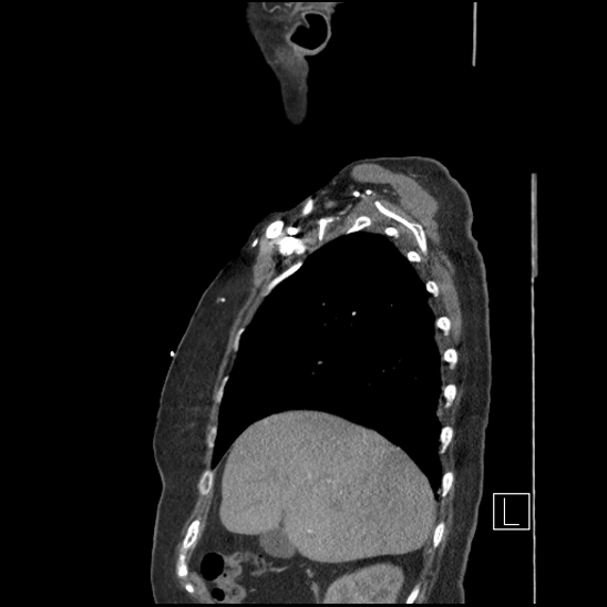File:Aortic intramural hematoma with dissection and intramural blood pool (Radiopaedia 77373-89491 D 18).jpg