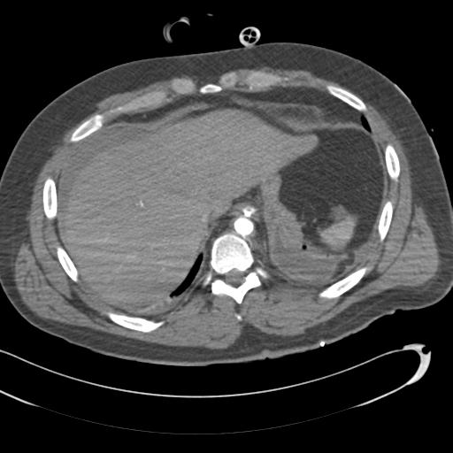 Aortic transection, diaphragmatic rupture and hemoperitoneum in a complex multitrauma patient (Radiopaedia 31701-32622 A 72).jpg