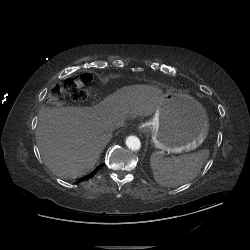 File:Aortoesophageal fistula with endovascular repair (Radiopaedia 73781-84592 Axial C+ CTPA 151).jpg