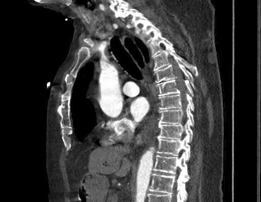 Aortoesophageal fistula with endovascular repair (Radiopaedia 73781-84592 Sagittal C+ CTPA 95).jpg