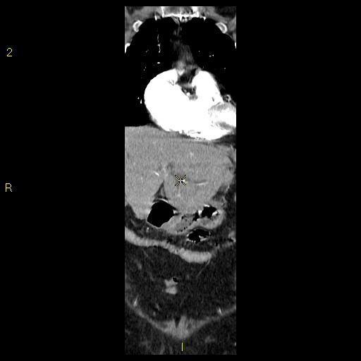 File:Aortoiliac occlusive disease (Radiopaedia 16828-16548 B 19).jpg